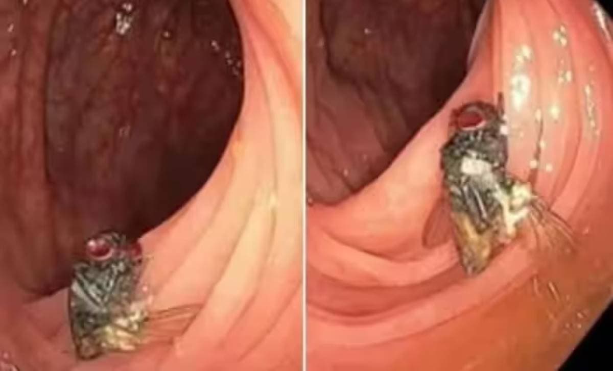 नियमित जांच के दौरान व्यक्ति की आंत में डॉक्टर को मिली सही सलामत मक्खी, वैज्ञानिकों के लिए दुर्लभ खो